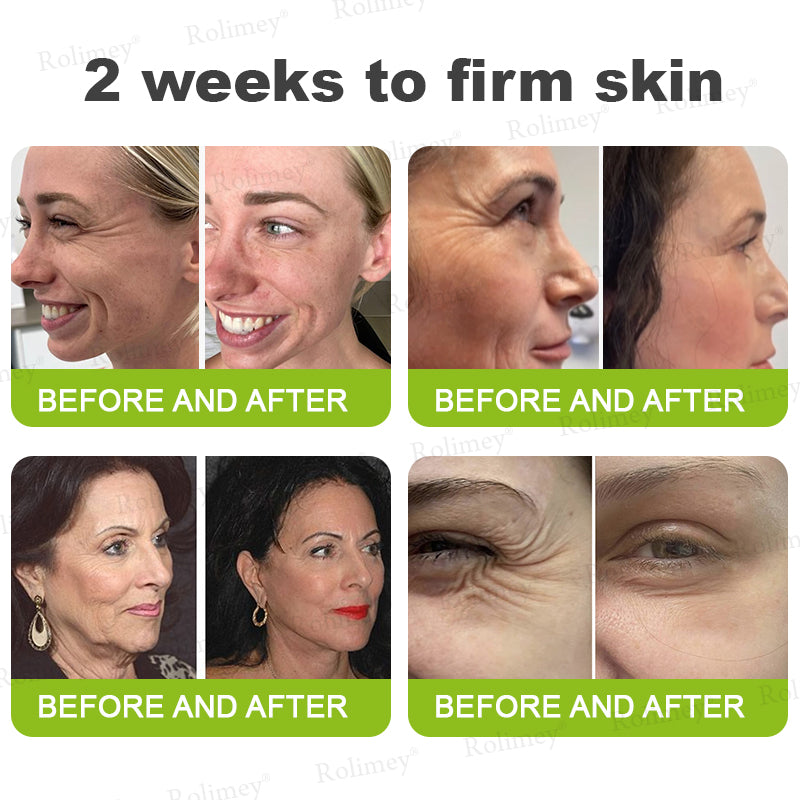 💛✅Произведено и изпратено от САЩ 💫Rolimey® Botox & Vita-A Retinol Shot крем за повдигане, стягане и изглаждане на бръчки – Последен ден на промоцията: 70% ОТСТЪПКА