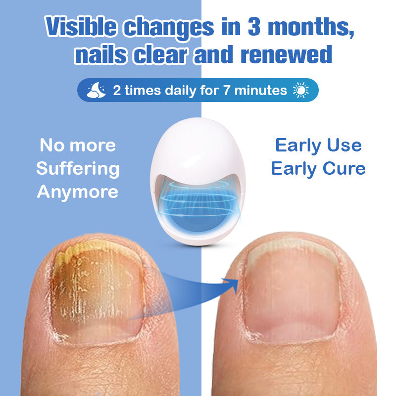 (🔥Ограничена отстъпка 70% - последен ден🔥)Furzero™ Лазерно устройство за премахване на гъбички по ноктите