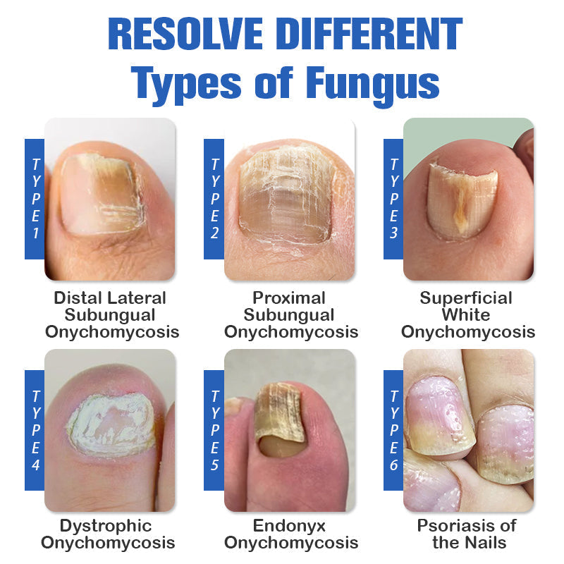 (🔥Ограничена отстъпка 70% - последен ден🔥)Furzero™ Лазерно устройство за премахване на гъбички по ноктите