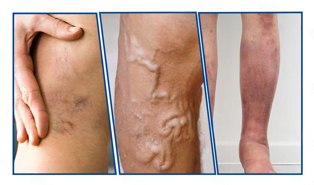 ✅👩‍⚕️👩‍⚕️ Healrize® VeinTarget микроиглен пластир ⚡ Незабавно облекчение, дълготрайни резултати
