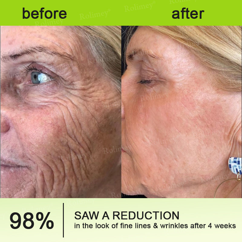 💛✅Произведено и изпратено от САЩ 💫Rolimey® Botox & Vita-A Retinol Shot крем за повдигане, стягане и изглаждане на бръчки – Последен ден на промоцията: 70% ОТСТЪПКА