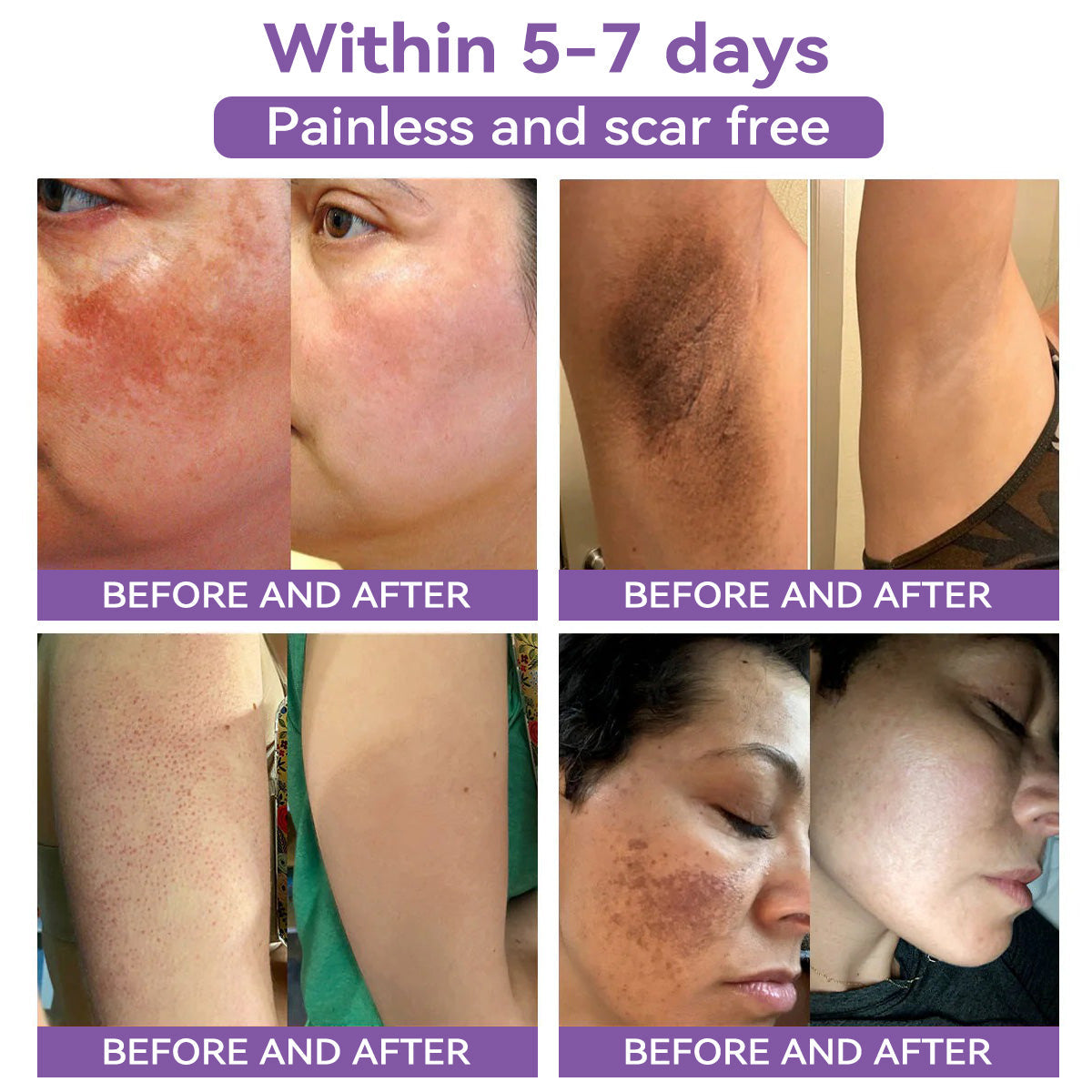 Totai Увереността в кожата започва оттук ✅ Bostore® Нано микроигли с хиалуронова киселина за възстановяване на кожата ✴️ За различни белези, стрии, петна, келоиди, кератози, акне, изгаряния, брадавици, кожни израстъци и разширени вени.