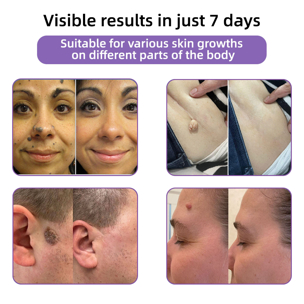 Totai Увереността в кожата започва оттук ✅ Bostore® Нано микроигли с хиалуронова киселина за възстановяване на кожата ✴️ За различни белези, стрии, петна, келоиди, кератози, акне, изгаряния, брадавици, кожни израстъци и разширени вени.