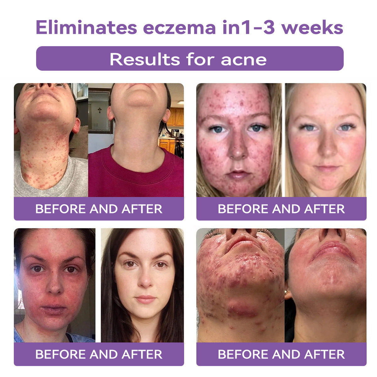 Totai Увереността в кожата започва оттук ✅ Bostore® Нано микроигли с хиалуронова киселина за възстановяване на кожата ✴️ За различни белези, стрии, петна, келоиди, кератози, акне, изгаряния, брадавици, кожни израстъци и разширени вени.