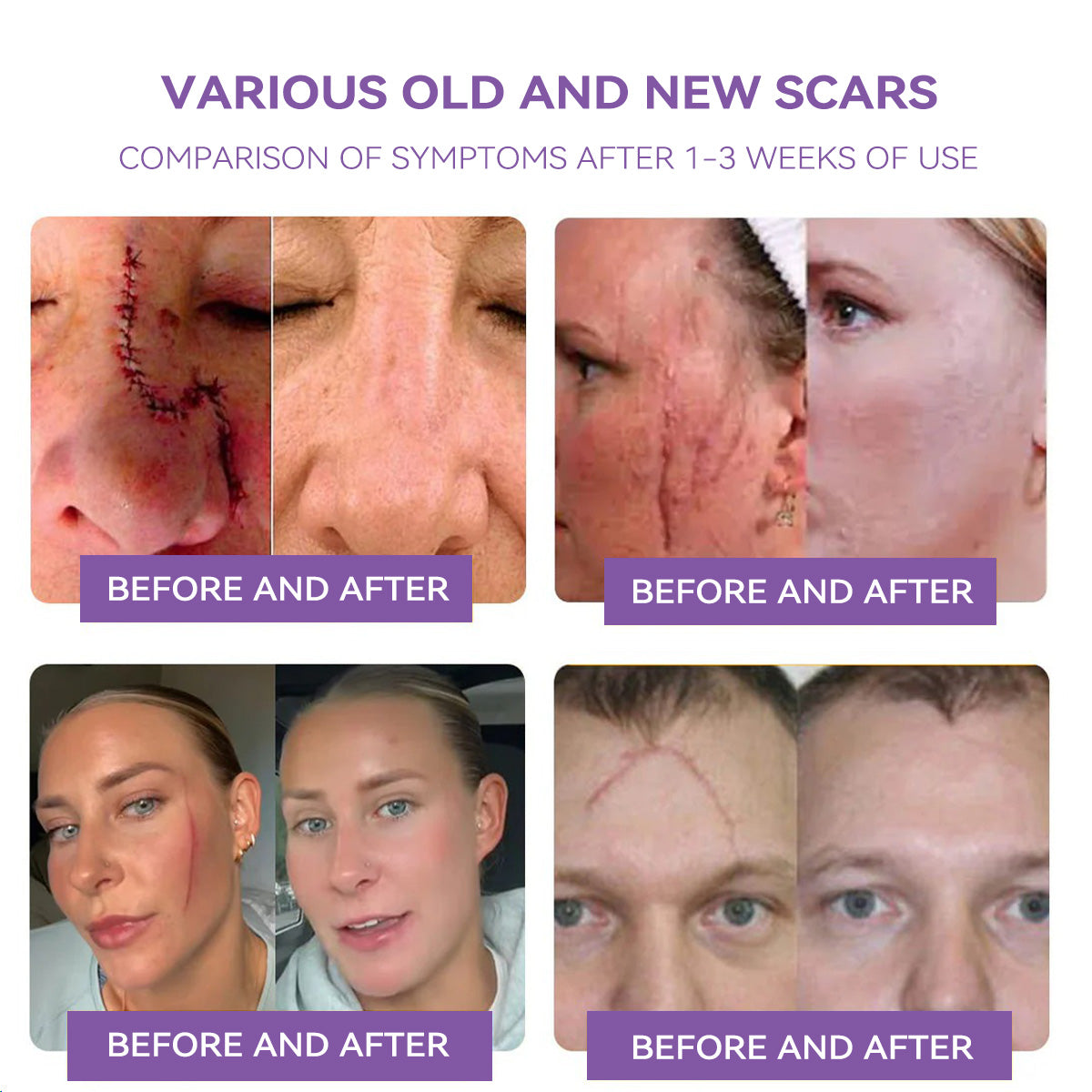 Totai Увереността в кожата започва оттук ✅ Bostore® Нано микроигли с хиалуронова киселина за възстановяване на кожата ✴️ За различни белези, стрии, петна, келоиди, кератози, акне, изгаряния, брадавици, кожни израстъци и разширени вени.