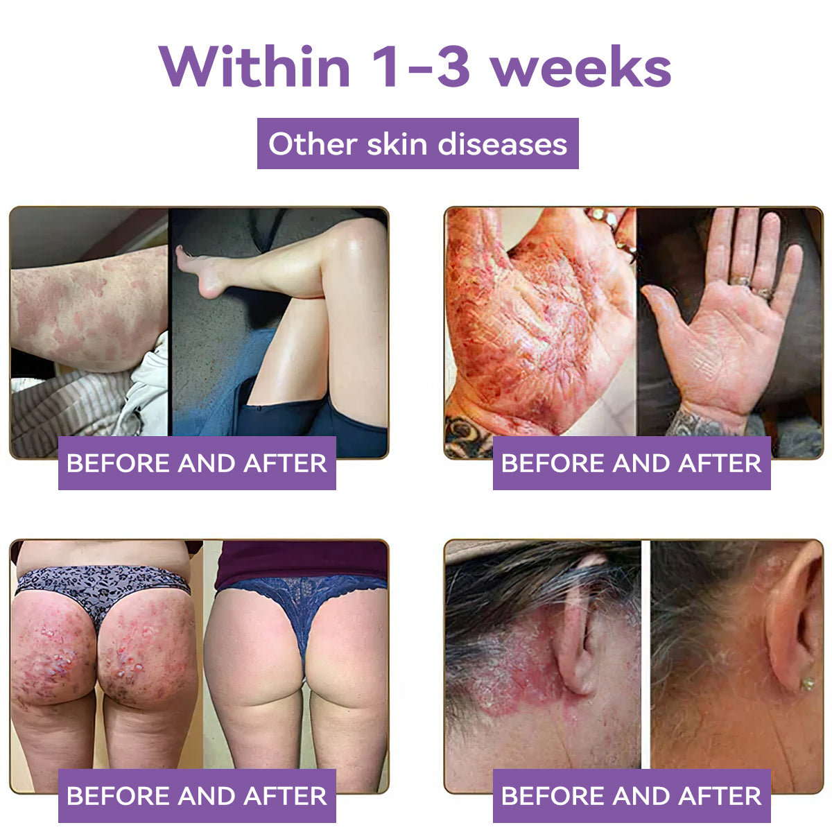 Totai Увереността в кожата започва оттук ✅ Bostore® Нано микроигли с хиалуронова киселина за възстановяване на кожата ✴️ За различни белези, стрии, петна, келоиди, кератози, акне, изгаряния, брадавици, кожни израстъци и разширени вени.