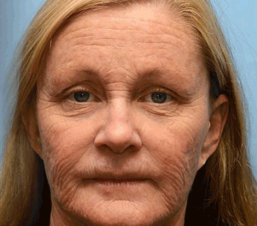 Последен промоционален ден: 70% отстъпка - ✨Furzero™ крем за премахване на бръчки с пчелна отрова Botox